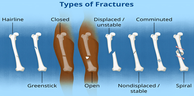 fracture doctor near me, orthopedic fracture doctor in Ahmedabad, Gujarat