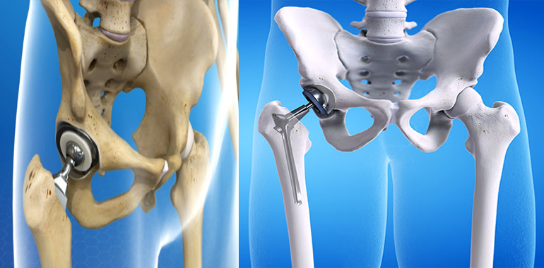 hip replacement surgeon/doctor/hospital/clnic ahmedabad, gujarat