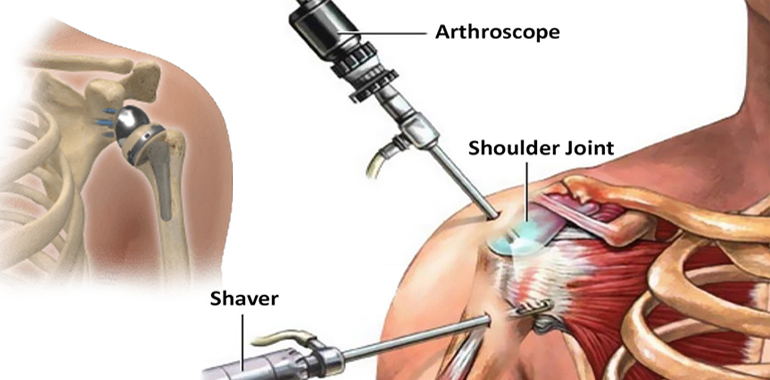 Elbow, Shoulder  Specialist Surgeon in Ahmedabad, muscle specialist doctor