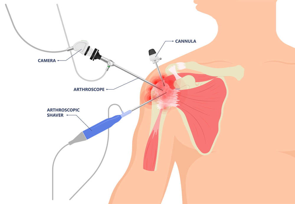 Elbow, Shoulder Arthroscopy Doctor/Surgeon in Ahmedabad