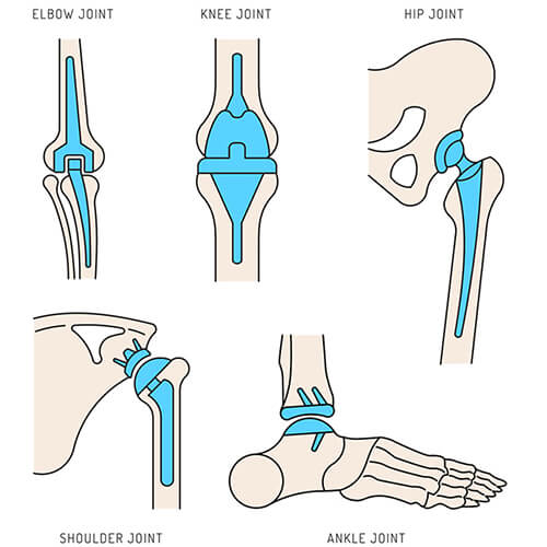 Best Joint Replacement Surgeon/Doctor/Hospital in Ahmedabad, Gujarat