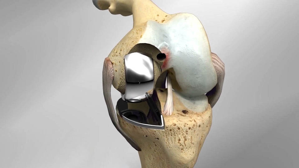 Best Microplasty (Partial Knee Replacement) surgery Surgeon/Doctor/Hospital/Clinic in Ahmedabad, Gujarat, Microplasty (Partial Knee Replacement) doctor Ahmedabad, Microplasty (Partial Knee Replacement) surgeon Ahmedabad