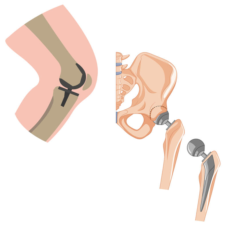 Revision knee & hip replacement surgeon Ahmedabad, Gujarat