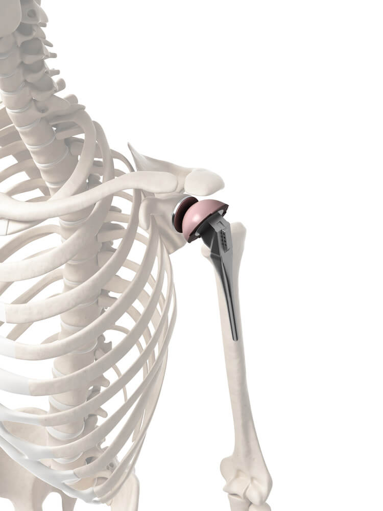 Elbow, Shoulder  Specialist Surgeon in Ahmedabad, muscle specialist doctor